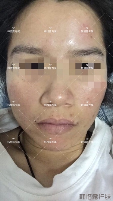 膿包痘祛痘效果，擁有干凈的臉不等待！