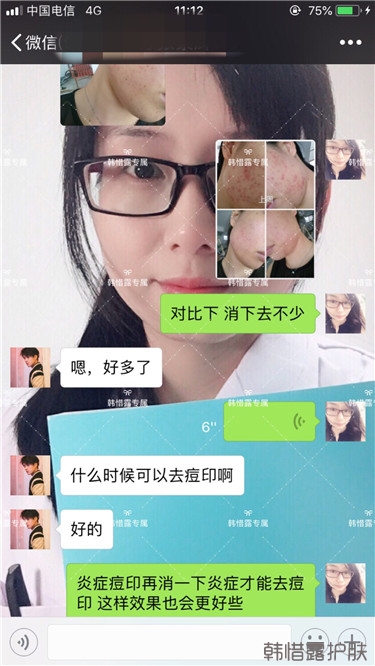 痘痘好多了，認真聽話按照要求使用，每個人都可以變很美！