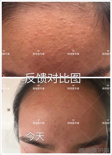 粉刺怎么辦？粉刺去除反饋：不要被粉刺遮住光潔的額頭