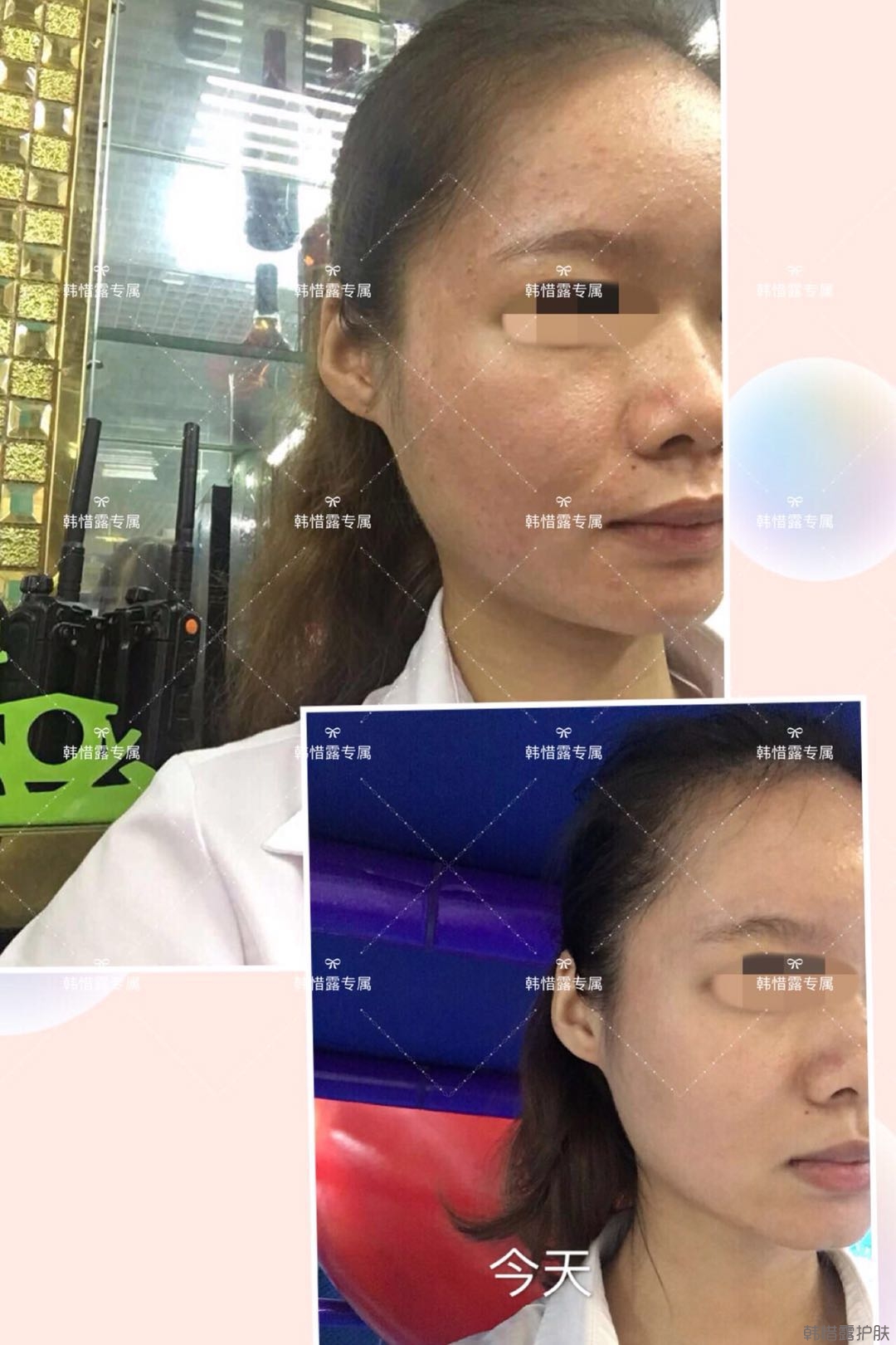 閉口粉刺怎么去除?嚴(yán)格按要求使用，粉刺效果不錯(cuò)！