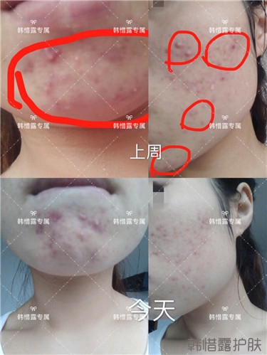 粉刺只剩一點點了，敏感肌粉刺修復(fù)，更美麗！