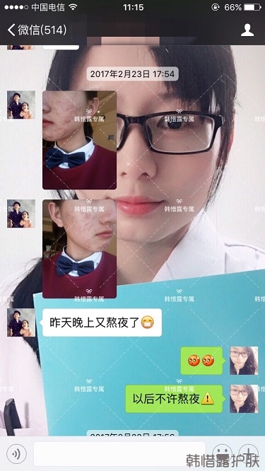 臉上長(zhǎng)痘痘怎么去掉？徹底告別痘痘，自卑到自信的蛻變！