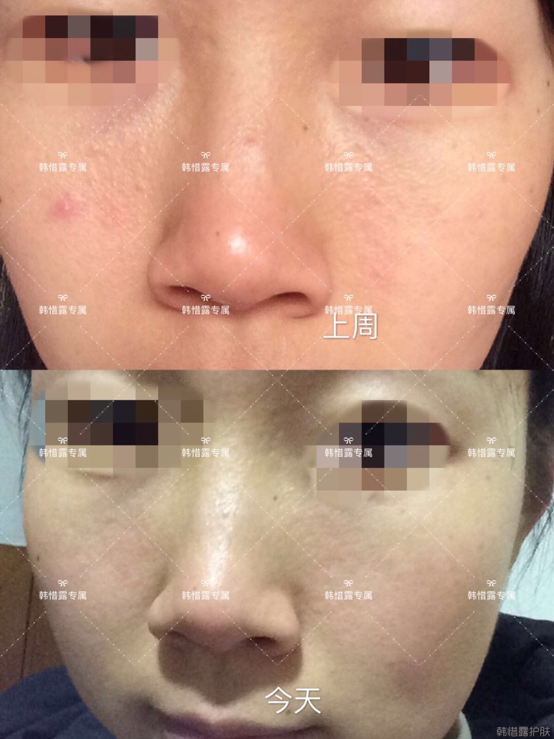 粉刺痘痘怎么有效去除？以前不敢拍燈光下照片，粉刺少了，現(xiàn)在敢了！