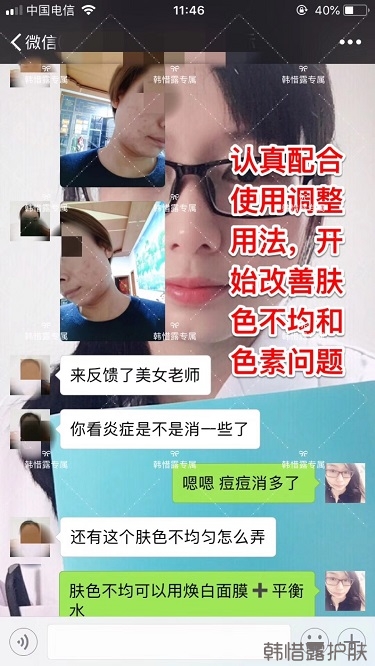 臉上一直長痘痘膿包怎么解決？痘痘開始消了，更美麗！