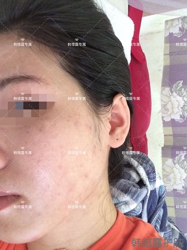 激素臉滿臉粉刺痘痘到光滑健康肌膚的蛻變