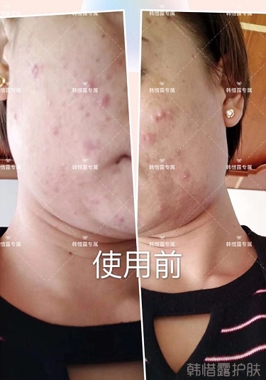 臉上一直長痘痘膿包怎么解決？痘痘開始消了，更美麗！