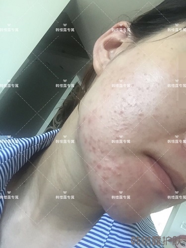 粉刺痘痘，痘印都沒了，寶媽重回顏值巔峰！