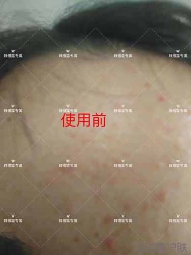 額頭長(zhǎng)痘臉頰長(zhǎng)痘痘粉刺，這樣調(diào)理幫你恢復(fù)嫩白肌膚！