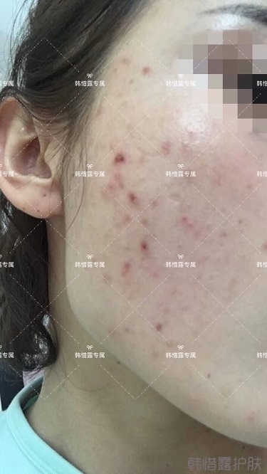 痘痘好了皮膚美麗，不想再記起曾經(jīng)滿臉痘痘的自己！