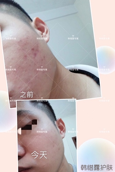 粉刺、痘痘、痘印、統(tǒng)統(tǒng)解決啦！祛痘去粉刺就是這么簡單！