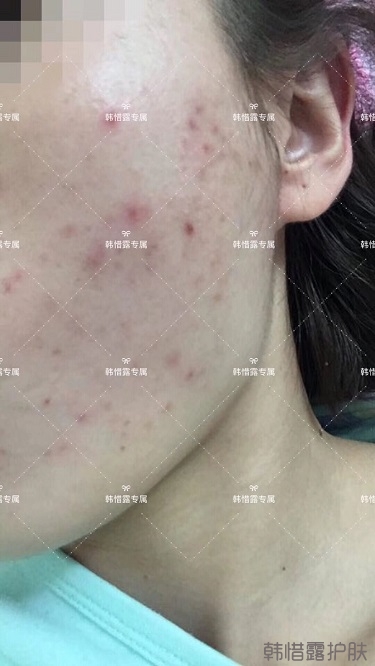 痘痘好了皮膚美麗，不想再記起曾經(jīng)滿臉痘痘的自己！