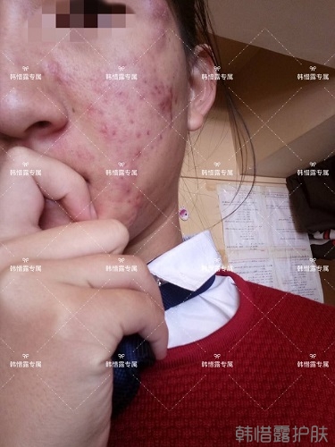 臉上長(zhǎng)痘痘怎么去掉？徹底告別痘痘，自卑到自信的蛻變！