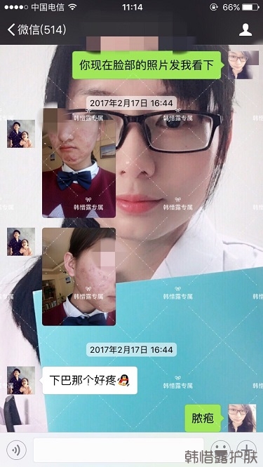 臉上長(zhǎng)痘痘怎么去掉？徹底告別痘痘，自卑到自信的蛻變！