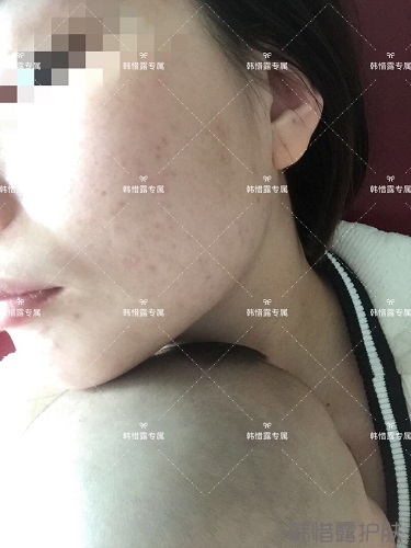 粉刺痘痘，痘印都沒了，寶媽重回顏值巔峰！