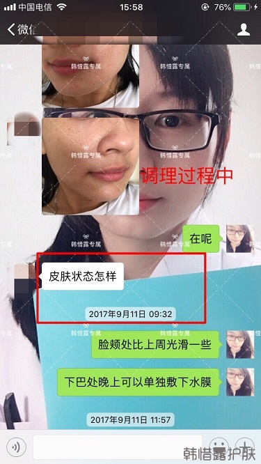 粉刺密密麻麻，試過很多方法無果后找韓惜露老師輕松去掉粉刺！