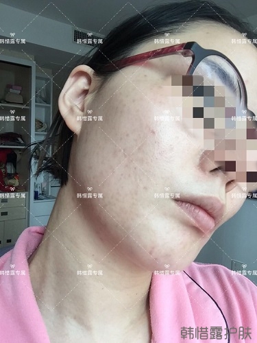 粉刺痘痘，痘印都沒了，寶媽重回顏值巔峰！