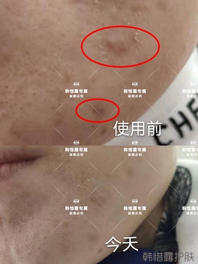 怎么消除臉上的痘痘，發(fā)硬膿包消下去了