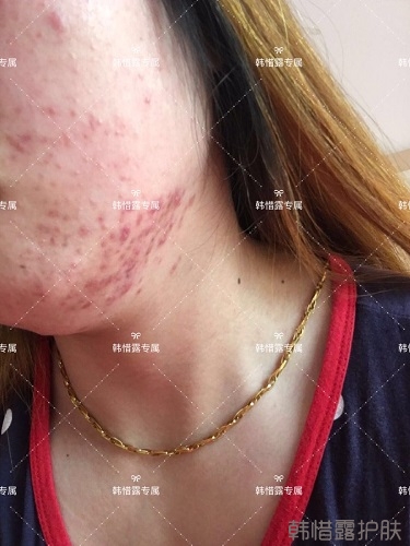 下巴長痘怎么辦？看這里徹底去掉痘痘，不再長痘了！