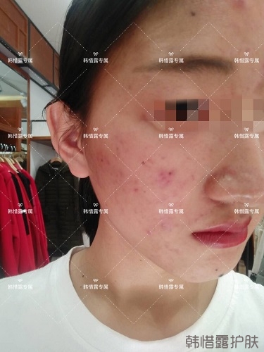 臉上長(zhǎng)痘痘怎么去掉？徹底告別痘痘，自卑到自信的蛻變！