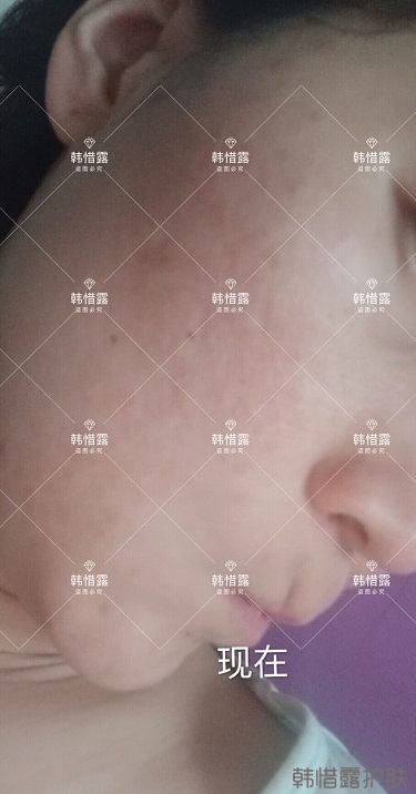 化妝品店主的變臉級祛痘反饋，粉刺痘痘全部消了