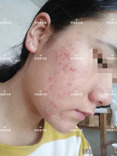 好好使用，膿包痘痘,小粉刺全消了,重點修復(fù)痘印痘坑印了