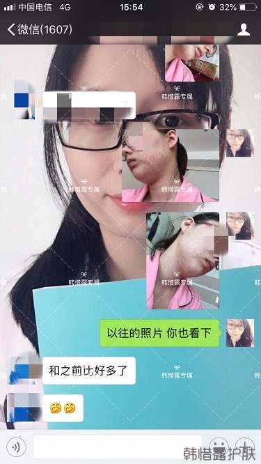 粉刺痘痘，痘印都沒了，寶媽重回顏值巔峰！