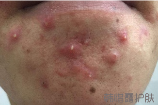下巴長(zhǎng)痘痘是什么原因