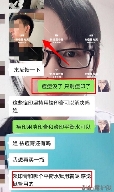 痘印怎么去？痘印調(diào)理案例，痘印淡化了