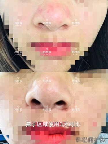 鼻子發(fā)紅長痘痘消了，皮膚吸收好就是任性！