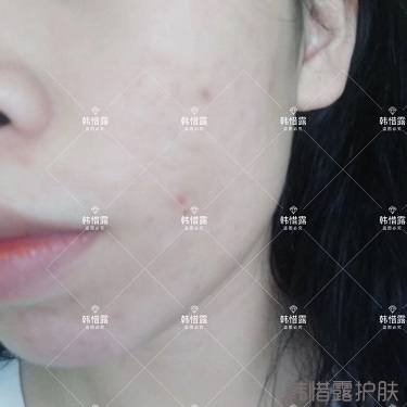 祛痘后判若兩人，膿包痘消了變小仙女