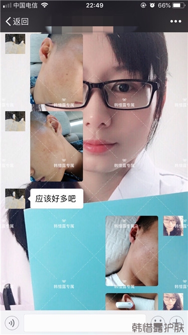 粉刺消了，皮膚光滑了，變帥氣不少呦！