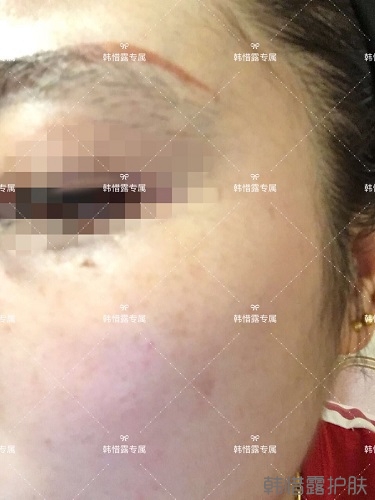 下巴長痘怎么辦？看這里徹底去掉痘痘，不再長痘了！