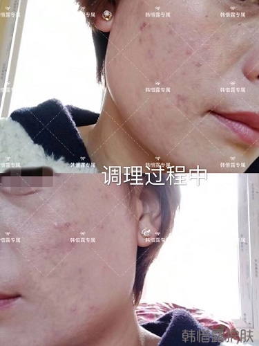 臉上一直長痘痘膿包怎么解決？痘痘開始消了，更美麗！