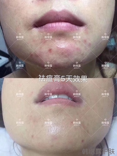 祛痘消炎水效果