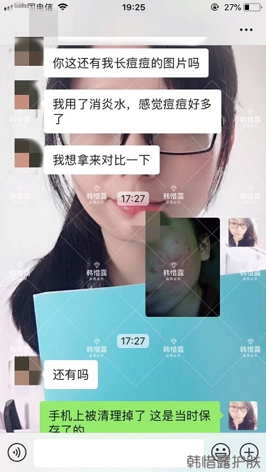 祛痘后判若兩人，膿包痘消了變小仙女