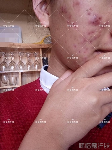 臉上長(zhǎng)痘痘怎么去掉？徹底告別痘痘，自卑到自信的蛻變！