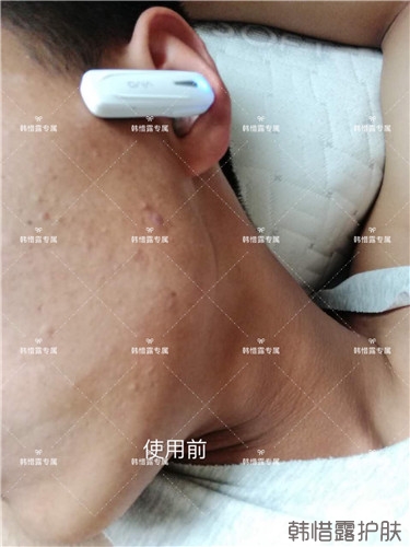 粉刺消了，皮膚光滑了，變帥氣不少呦！