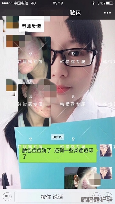 膿包痘痘好了，從慘不忍睹到變美變漂亮