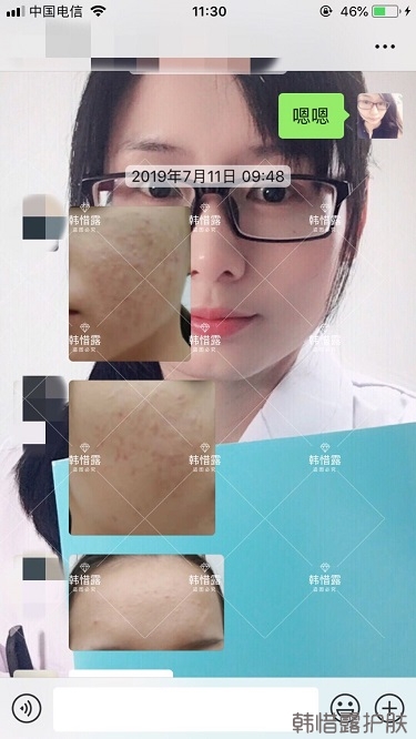 去粉刺效果，單用粉刺膏與祛痘霜也能快快溶解粉刺！