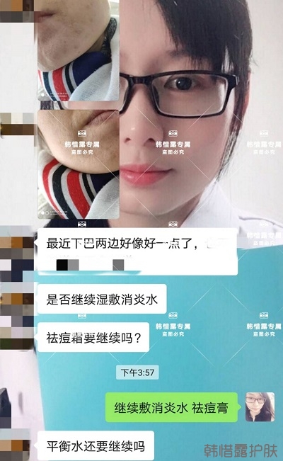 怎么消除臉上的痘痘，發(fā)硬膿包消下去了