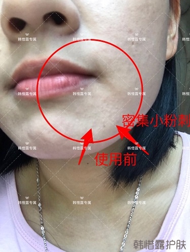 粉刺密密麻麻，試過很多方法無果后找韓惜露老師輕松去掉粉刺！
