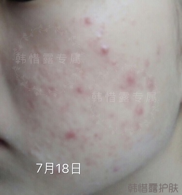 去粉刺效果，單用粉刺膏與祛痘霜也能快快溶解粉刺！