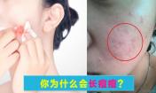 臉上長痘痘是什么原因？請問主要是什么原因呢？