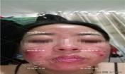 【祛痘視頻反饋】激素臉長(zhǎng)痘20多年，大膿包，發(fā)癢，完全恢復(fù)！